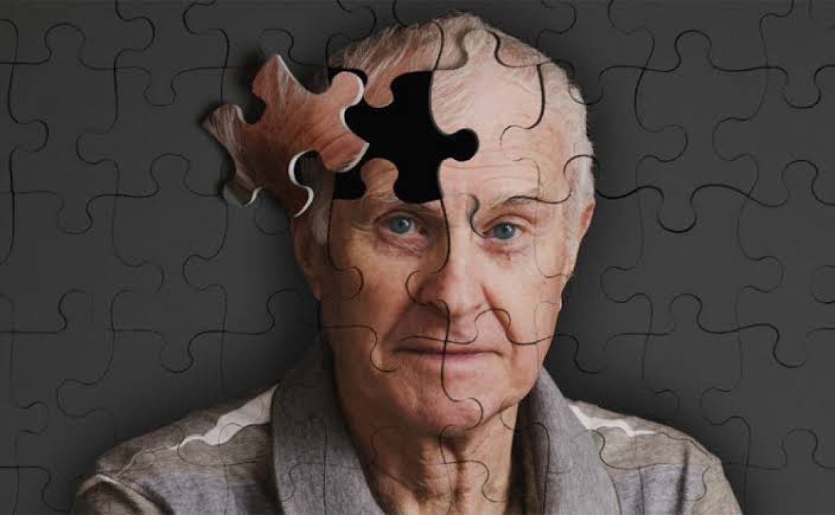 Avrupa'da İlk Kez: Alzheimer Hastalığını Önlemeye Yönelik Devrim Niteliğinde Deney Başlıyor