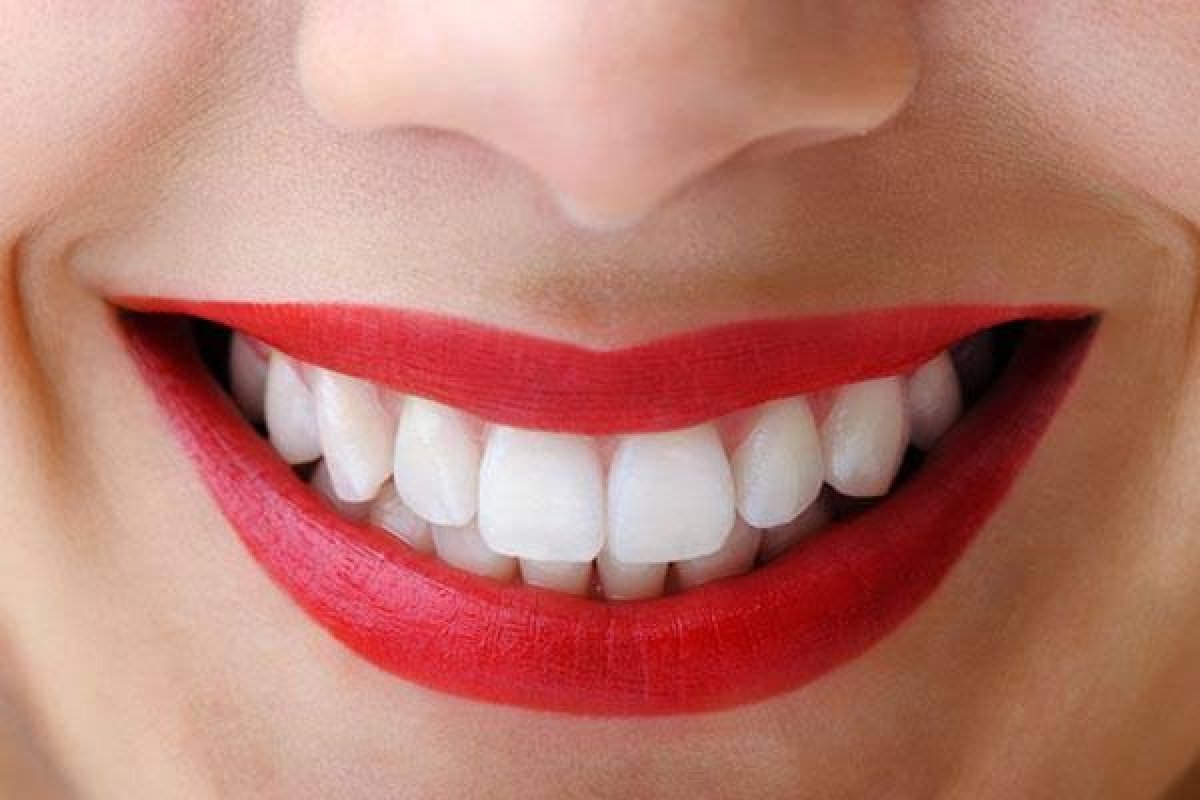 Diş Beyazlatmada Riskler: Ev Ürünleri ve Sosyal Medya Yöntemleri Tehlikeli Olabilir